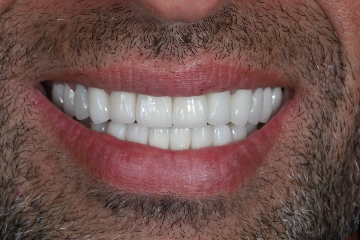After smile transformation at Glisten Dental