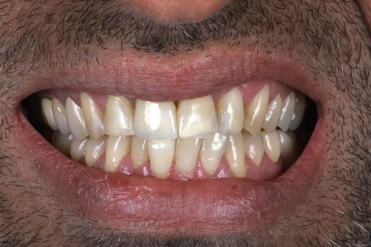 Before smile transformation at Glisten Dental