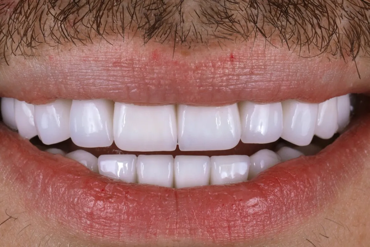 Full smile transformation result at Glisten Dental