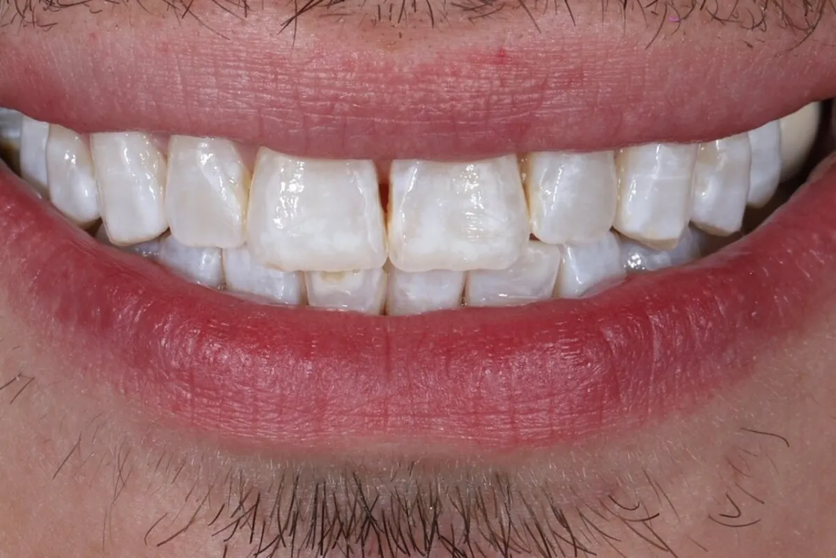 Before smile transformation at Glisten Dental