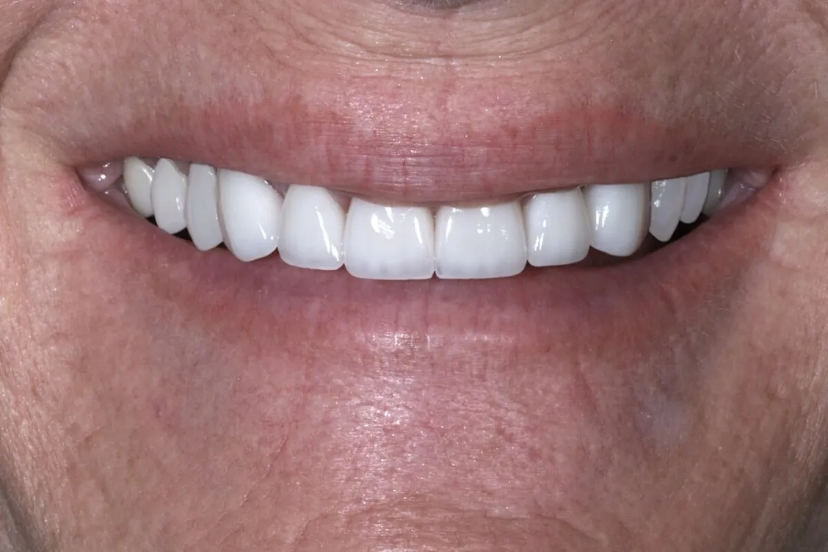 Smile transformation at Glisten Dental