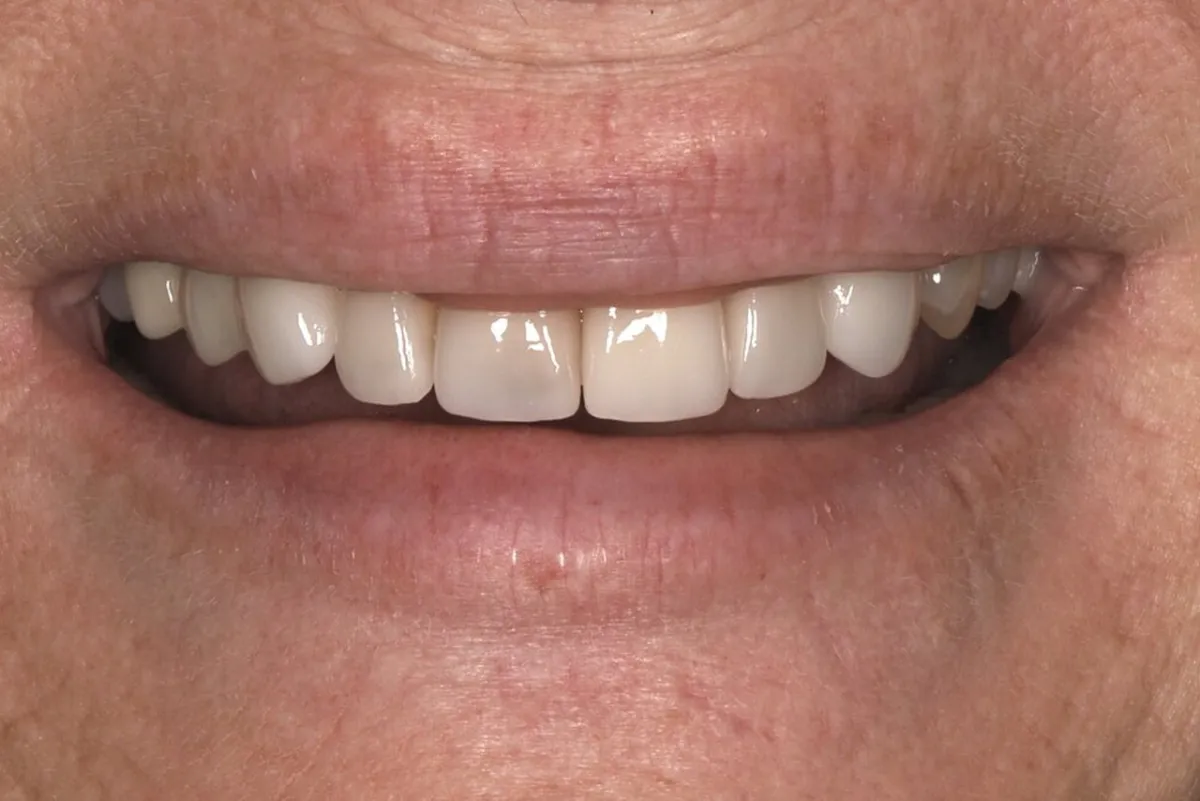 Before smile transformation at Glisten Dental